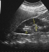 Image result for Transiente Kortikomedullaere Echogenitaetserhoehung der Neugeborenen-niere. Size: 172 x 185. Source: www.praxisfaure.de