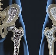 Afbeeldingsresultaten voor Osteoporosis Agency Environ. Grootte: 187 x 185. Bron: www.livescience.com