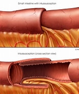 Image result for Duenndarm-invagination. Size: 156 x 185. Source: www.mayoclinic.org