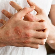 Image result for Arcutis Atopic Dermatitis. Size: 186 x 185. Source: www.academicallderm.com