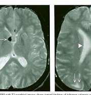 Image result for Tuberöse Hirnsklerose mit Hemimegalencephalie. Size: 179 x 185. Source: www.semanticscholar.org