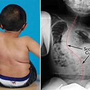 Image result for Osteogenesis Imperfecta � Glasknochenerkrankung. Size: 185 x 185. Source: www.noticiasbarquisimeto.com