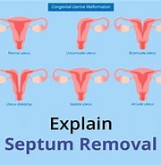 Risultato immagine per uterus Septum Entfernung. Dimensioni: 180 x 179. Fonte: birlafertility.com