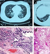 Image result for Zystisch adenomatoide malformation der Lunge. Size: 172 x 185. Source: diagnosticpathology.biomedcentral.com