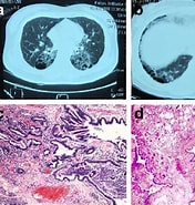 Image result for Zystisch adenomatoide malformation der Lunge. Size: 176 x 185. Source: diagnosticpathology.biomedcentral.com