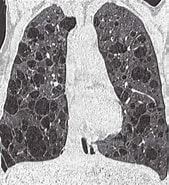 Image result for Lymphangioleiomyomatose. Size: 169 x 185. Source: www.pinterest.es