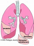 Lungensequester, Extralobulaer के लिए छवि परिणाम. आकार: 137 x 185. स्रोत: thefetus.net