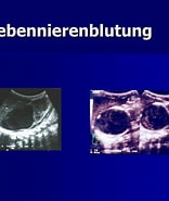 Image result for Nebennierenverkalkung Nach Nebennierenblutung. Size: 156 x 185. Source: www.slideserve.com