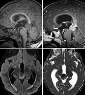 Image result for Pineoblastoma Symptoms. Size: 167 x 185. Source: www.neurosurgicalatlas.com
