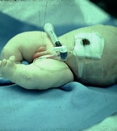 Bildergebnis für Baby Dysplasia. Größe: 165 x 185. Quelle: www.primehealthchannel.com