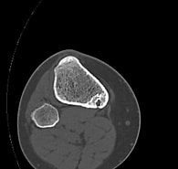 Bildergebnis für Osteoidosteom der Tibia. Größe: 195 x 185. Quelle: pacs.de
