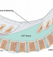 Bildergebnis für Tethered Spinal Cord Mit Einschluss-tm. Größe: 174 x 185. Quelle: www.barrowneuro.org