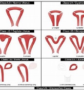Risultato immagine per uterus Septum Entfernung. Dimensioni: 172 x 185. Fonte: www.semanticscholar.org