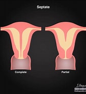 Risultato immagine per uterus Septum Entfernung. Dimensioni: 169 x 185. Fonte: radiopaedia.org