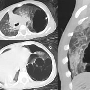 Image result for CCAM Zystisch adenomatoide Malformation der Lunge im fetalen MRT. Size: 185 x 185. Source: radrounds.com
