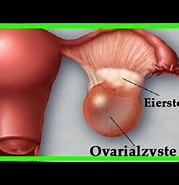Image result for Funktionelle Ovarialzyste Rechts. Size: 179 x 185. Source: www.youtube.com