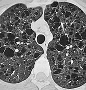 Bildergebnis für Lymphangioleiomyomatosis CT. Größe: 176 x 185. Quelle: www.sciencephoto.com