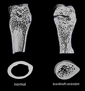 Image result for Osteopetrose Infantiler, Maligner Typ, Marmorknochenkrankheit. Size: 173 x 185. Source: healthcare-in-europe.com