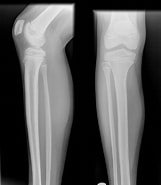 Osteoidosteom der Tibia に対する画像結果.サイズ: 161 x 185。ソース: radiopaedia.org