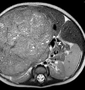 Image result for Hepatoblastom. Size: 175 x 185. Source: www.eurorad.org