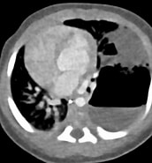 Image result for Zystisch adenomatoide malformation der Lunge. Size: 172 x 185. Source: pet-ct.com