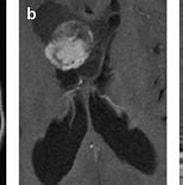 Image result for Tuberöse Hirnsklerose mit Hemimegalencephalie. Size: 183 x 109. Source: www.journalonko.de
