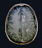 Image result for Neurocysticercose. Size: 162 x 185. Source: www.medicalnewstoday.com