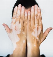 Image result for Vitiligo Disease Opzelura. Size: 173 x 185. Source: www.clinicaltrialsarena.com