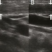 Image result for Sternocleidomastoid muscle on ultrasound. Size: 182 x 184. Source: www.researchgate.net