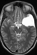 Image result for Arachnoidalzyste als Ursache Eines Hirninfarktes. Size: 126 x 185. Source: www.ars-neurochirurgica.com