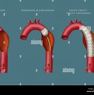Image result for Stenose der Aorta abdominalis bei einem Säugling. Size: 183 x 185. Source: www.alamy.de