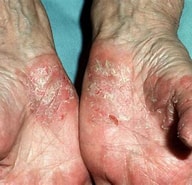 Image result for Palmoplantar Pustular Psoriasis.14. Size: 192 x 185. Source: www.huidarts.com
