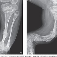Image result for Osteogenesis Imperfecta � Glasknochenerkrankung. Size: 185 x 185. Source: tatuaje.kulturaupice.cz