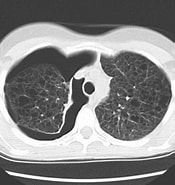 Bildergebnis für Lymphangioleiomyomatosis CT. Größe: 175 x 185. Quelle: radiopaedia.org