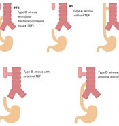 تصویر کا نتیجہ برائے �ösophagusatresie Typ Iiib. سائز: 175 x 185۔ ماخذ: www.lecturio.com
