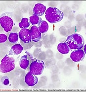 Image result for Burkitt-lymphoma C83.7. Size: 174 x 185. Source: www.leukemia-cell.org