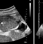 Image result for Leber-raumforderung - Fokale-noduläre-hyperplasie. Size: 183 x 121. Source: www.medical-tribune.de