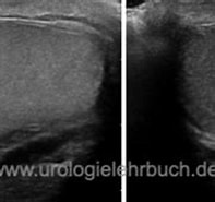 Image result for Hoden Sternenhimmelphänomen. Size: 197 x 124. Source: www.urologielehrbuch.de