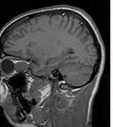 Bildergebnis für +Kapillaeres Haemangiom der Orbita. Größe: 164 x 101. Quelle: www.augenklinik-sulzbach.de