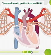 Bildergebnis für Transposition der großen Gefäße TGA. Größe: 172 x 185. Quelle: www.doccheck.com