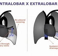 Lungensequester, Extralobulaer के लिए छवि परिणाम. आकार: 189 x 185. स्रोत: www.eurorad.org