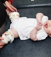 Bildergebnis für Baby Dysplasia. Größe: 165 x 185. Quelle: www.orthokids.com.au