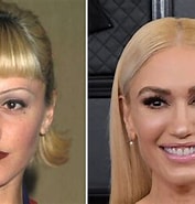 Bildresultat för What Happened To Gwen Stefani's Face. Storlek: 177 x 185. Källa: www.lifeandstylemag.com