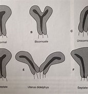 Image result for Uterus Didelphys bicollis. Size: 172 x 185. Source: 1964chris59.blogspot.com