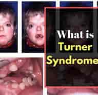 Billedresultat for World Dansk Sundhed sygdomme og lidelser neurologiske genetiske syndromer Turners syndrom. størrelse: 191 x 185. Kilde: www.youtube.com