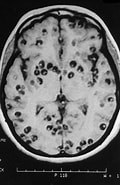 Image result for Neurocysticercose. Size: 120 x 185. Source: healthjade.net