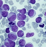 Image result for Leukemia Mesh. Size: 181 x 185. Source: www.verywellhealth.com