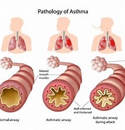 Image result for Astma Nhi. Size: 178 x 185. Source: www.abc-doctors.com