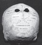 Image result for Foramina parietalia magna. Size: 175 x 185. Source: www.semanticscholar.org
