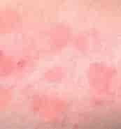 Sun Allergy Skin Rash-এর ছবি ফলাফল. আকার: 173 x 185. সূত্র: medicalpictures.net